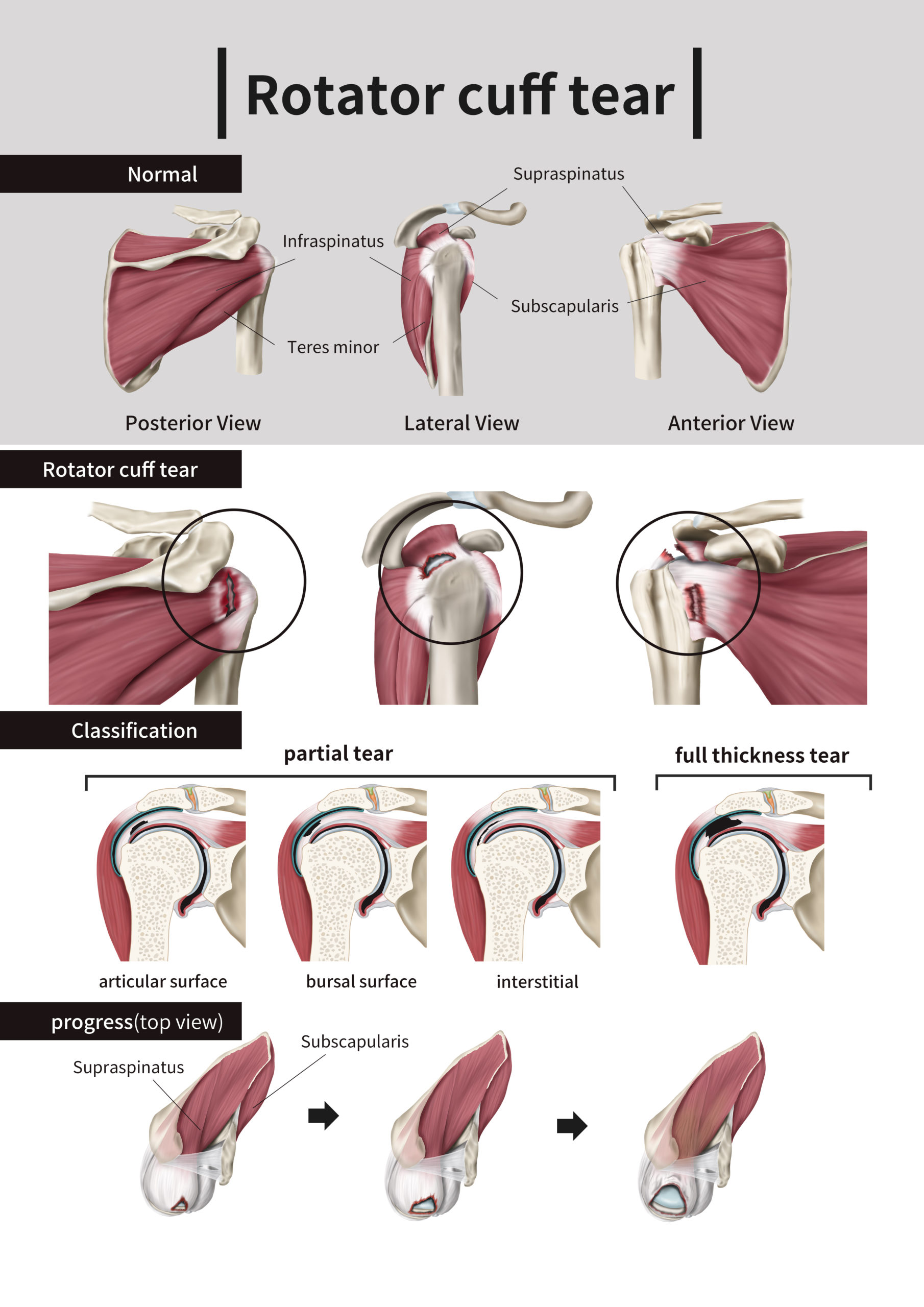 Rotator cuff tear diagram