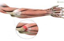 Tennis Elbow (Lateral Epicondylosis) - Idaho Shoulder to Hand