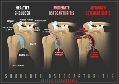 shoulder arthritis graphic