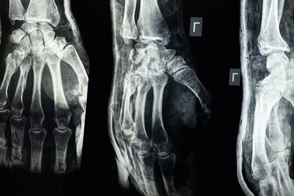 fractures-wrist-hand-fingers X-ray of hand bones for fracture assessment